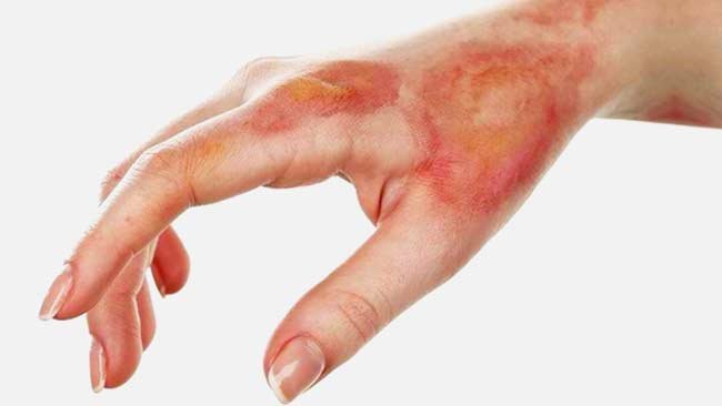 Kulit Melepuh Akibat Terkena Air Panas, Ini Cara Sederhana Mengobatinya