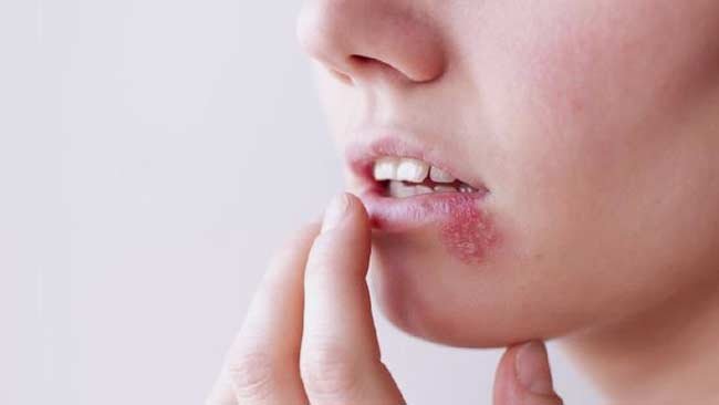 Mudah Menular, Wanita Lebih Cepat Tertular Virus Herpes daripada Pria