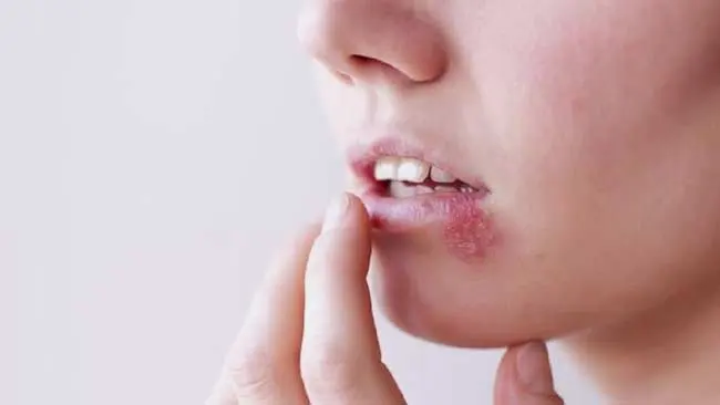 Mudah Menular, Wanita Lebih Cepat Tertular Virus Herpes daripada Pria