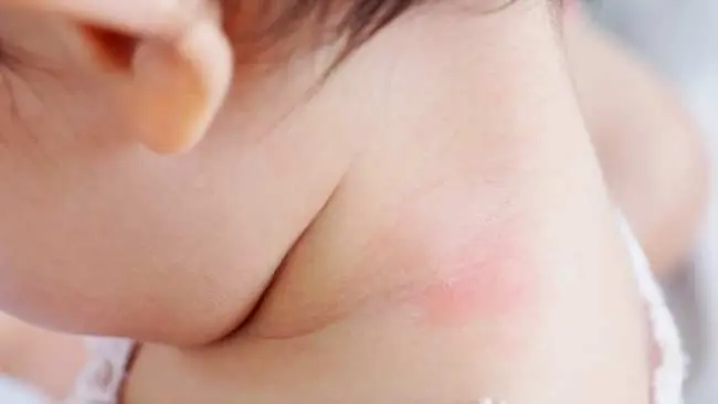 Begini Tips Redakan Biang Keringat pada Anak Saat Cuaca Panas