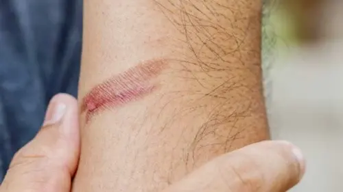 Jangan Pakai Odol, Ini Cara Tepat Obati Luka Bakar Ringan