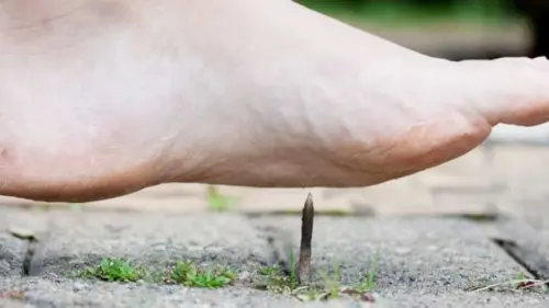 Tetanus Bisa Mematikan, Segera Atasi dengan Cara Ini