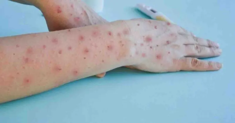 Tentang Mpox dan Upaya Indonesia Mencegah Penularannya