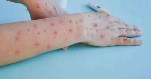 Tentang Mpox dan Upaya Indonesia Mencegah Penularannya